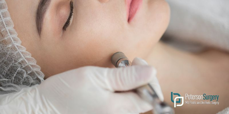 What to Expect During a Dermabrasion Treatment – Kelowna Dermabrasion